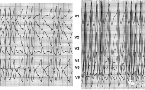 心动过速背后的秘密