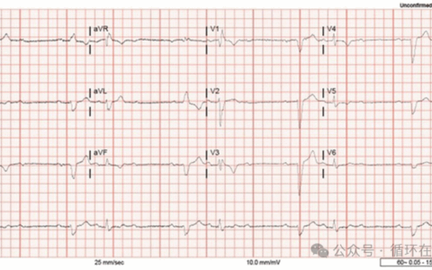 心脏的隐藏信号—交替性束支阻滞合并房室阻滞