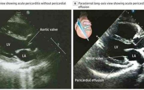 2020 ESC Guidelines for the management of adult congenital heart disease